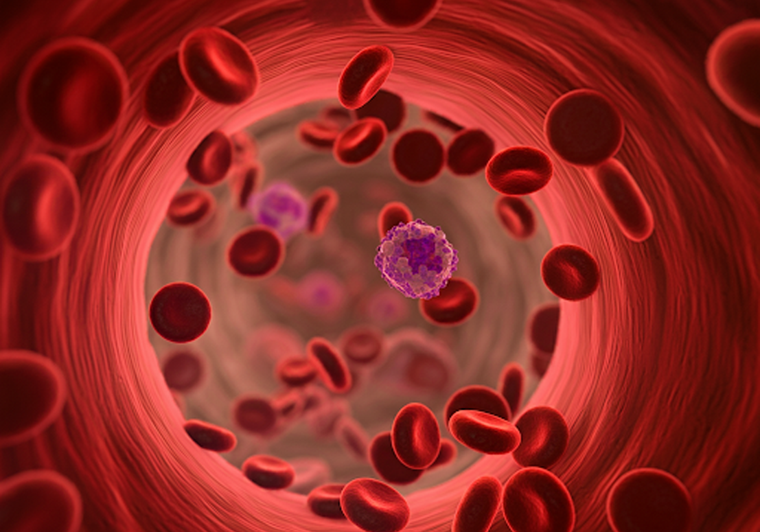 Sickle cell gene therapies roll out slowly